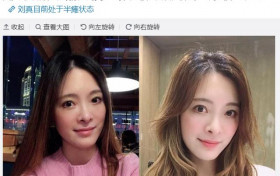 医生曝刘真半瘫痪 左半身已失去知觉